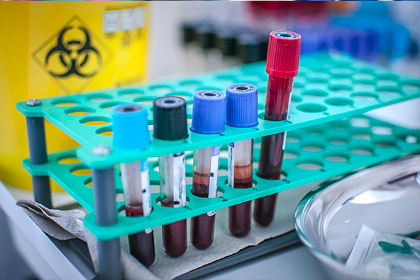 A rack of blood samples in a lab.